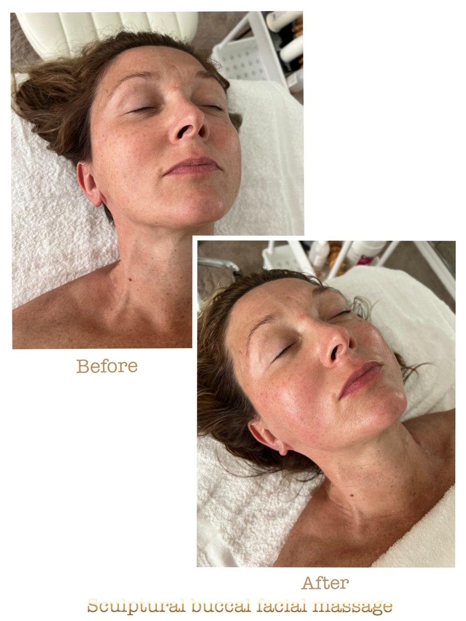 Пример до и после 4 после скульптурного буккального массажа лица в Nova Vita Esthetics