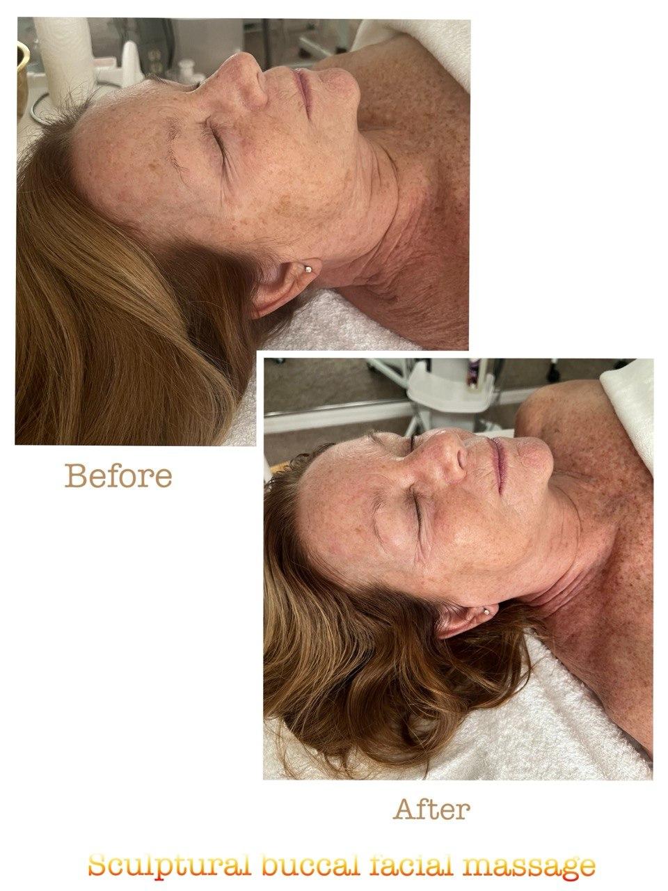 Пример до и после 6 после скульптурного буккального массажа лица в Nova Vita Esthetics