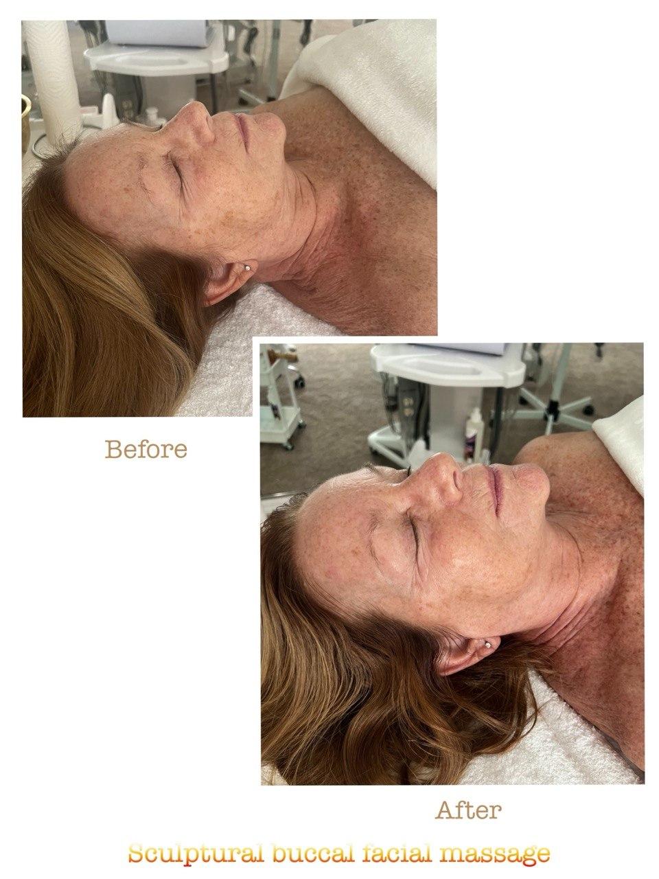 Пример до и после 7 после скульптурного буккального массажа лица в Nova Vita Esthetics