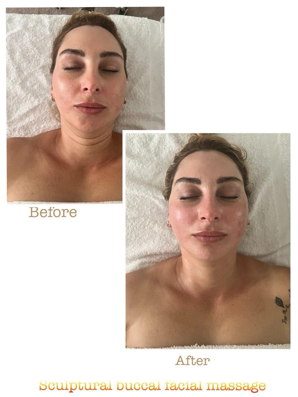 Пример до и после 8 после скульптурного буккального массажа лица в Nova Vita Esthetics