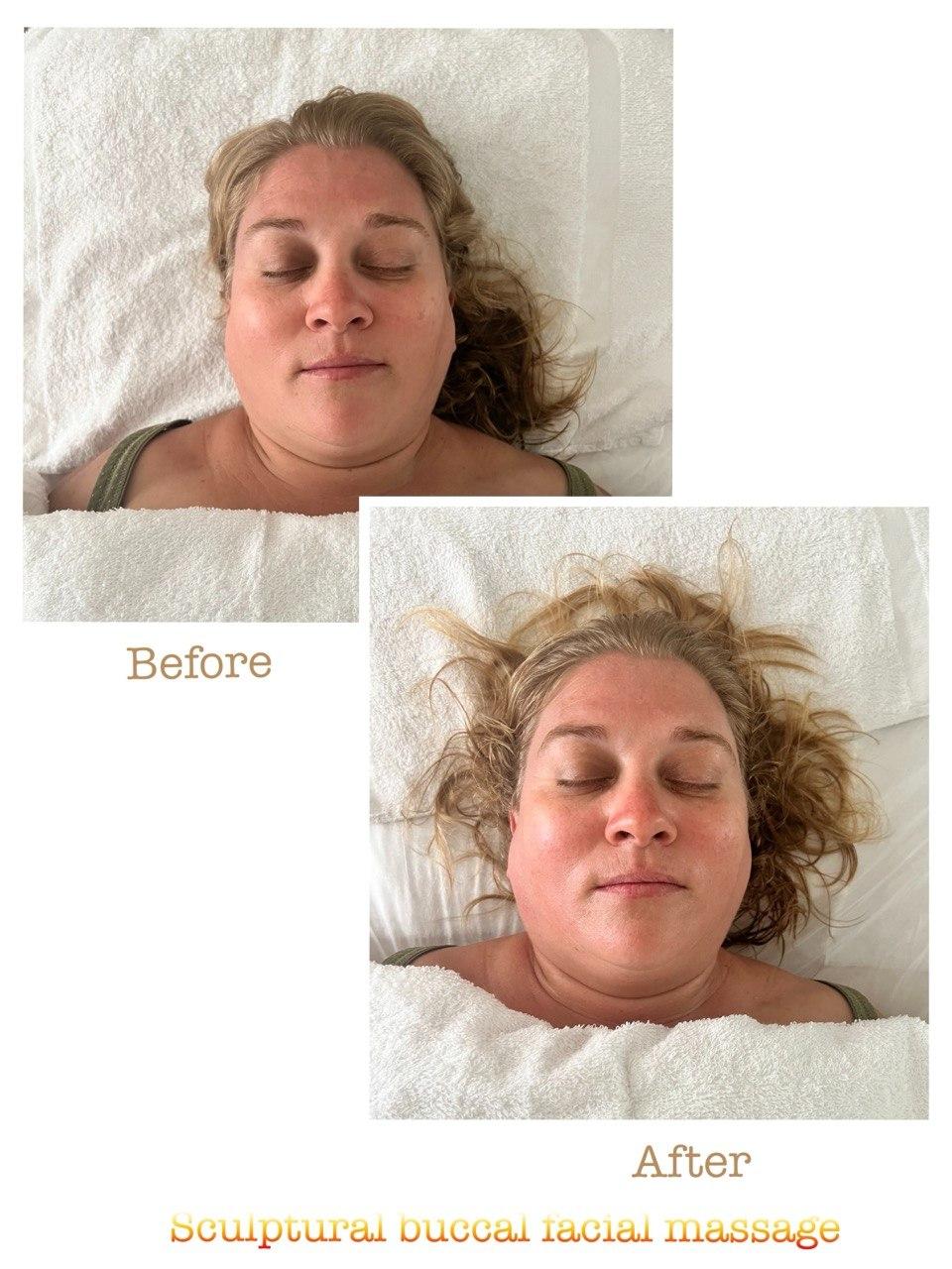 Пример до и после 9 после скульптурного буккального массажа лица в Nova Vita Esthetics