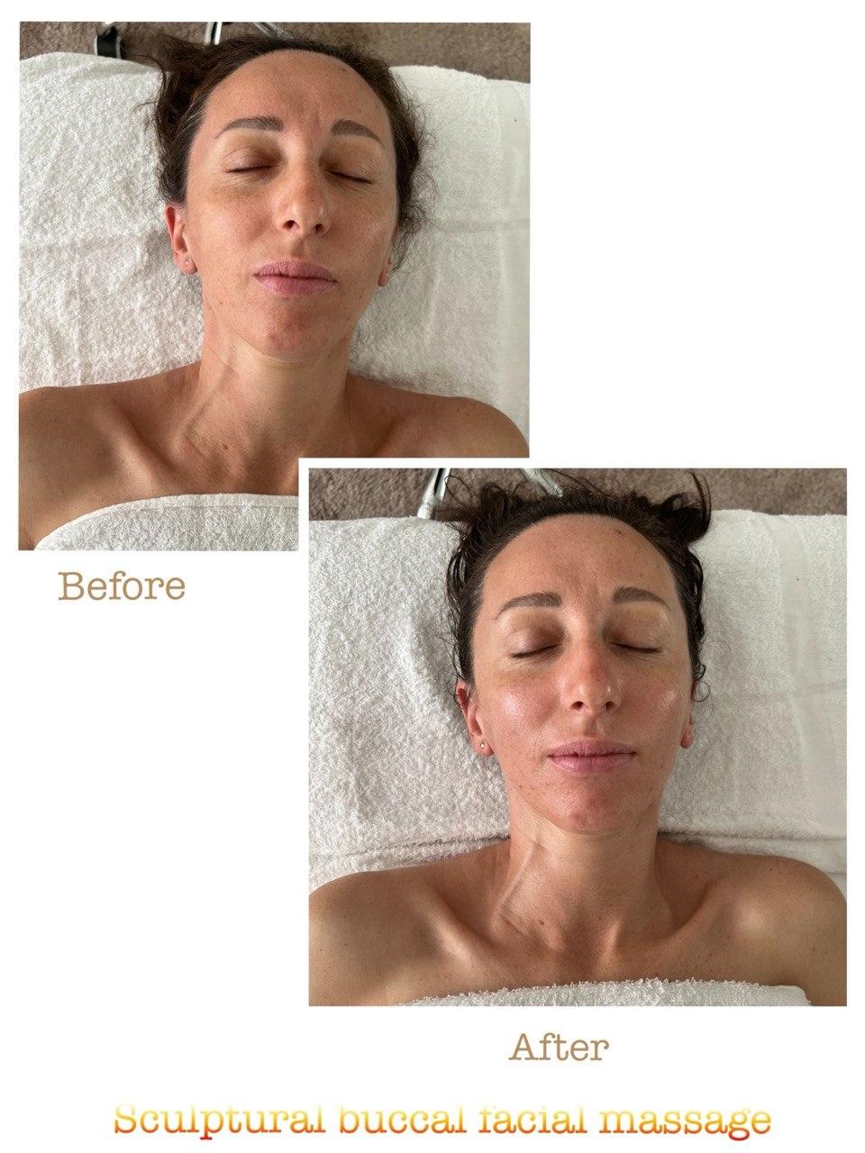 Пример до и после 10 после скульптурного буккального массажа лица в Nova Vita Esthetics