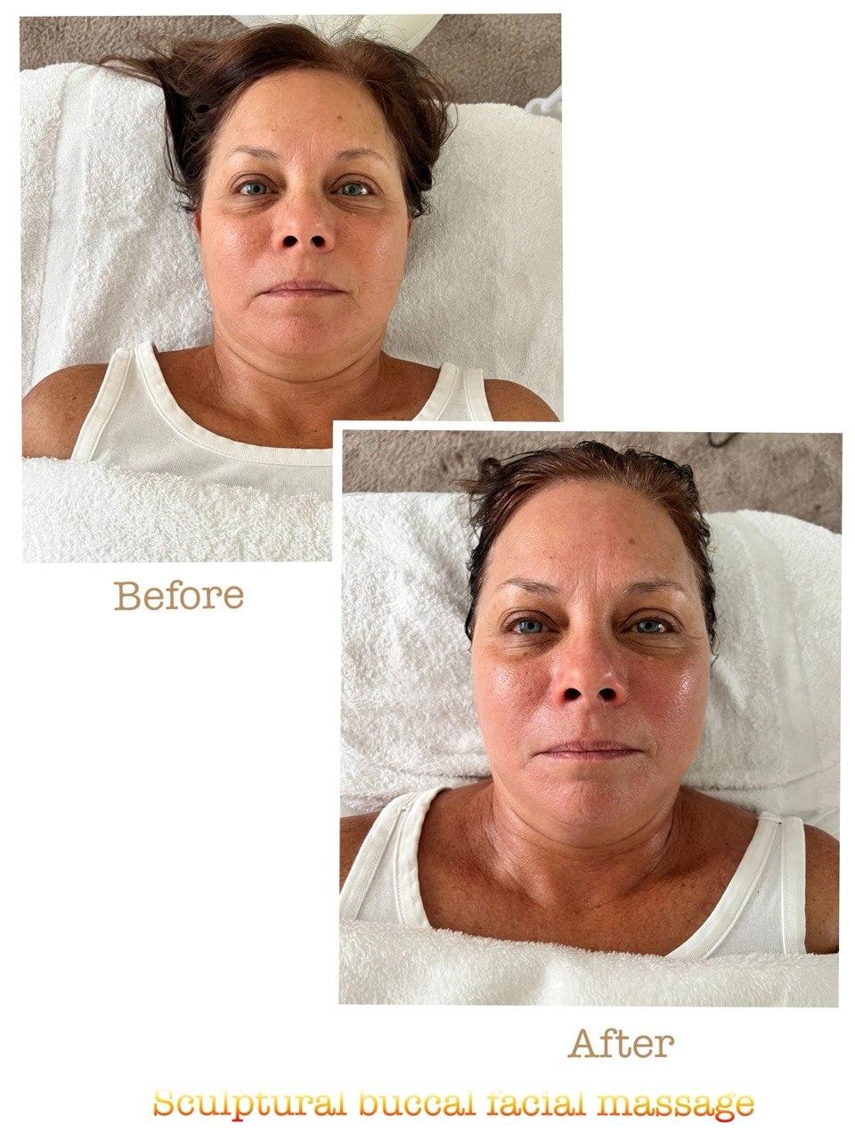 Пример до и после 11 после скульптурного буккального массажа лица в Nova Vita Esthetics