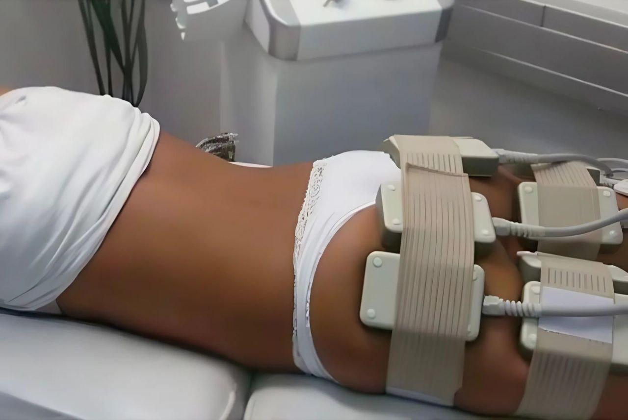 Laser Lipolysis